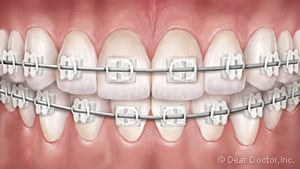 image of teeth with clear braces