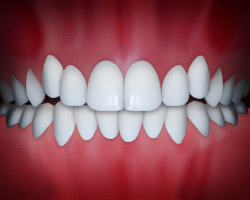image of crowding teeth