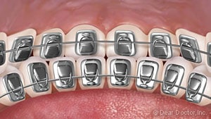 image of lingual braces