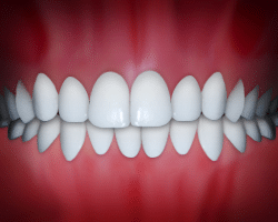 image of dental midlines not matched