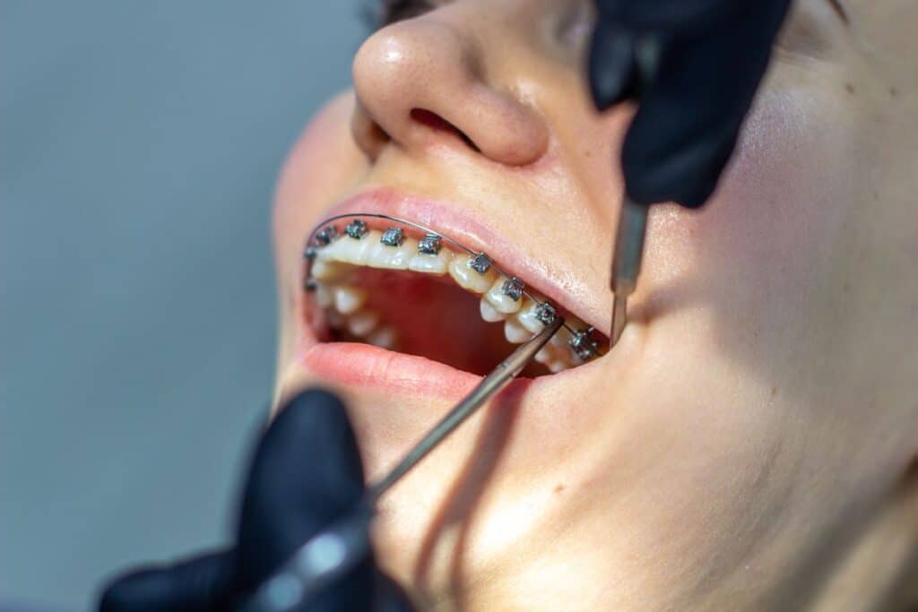 clear braces woodbridge