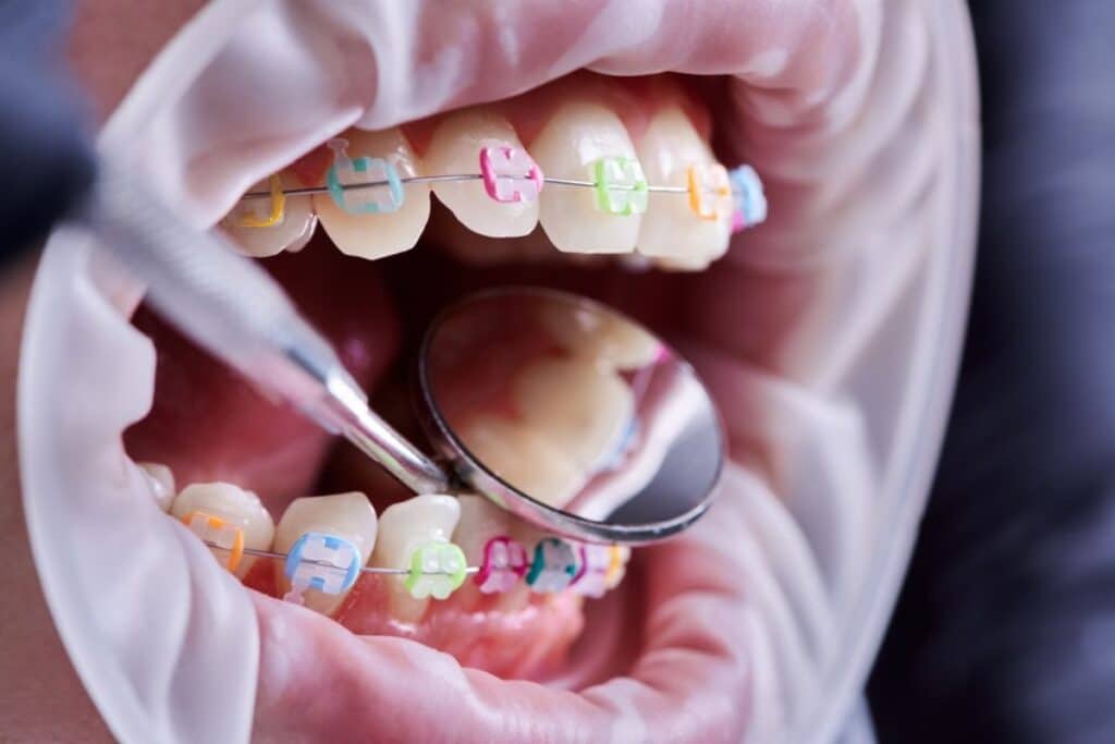 Braces in Woodbridge