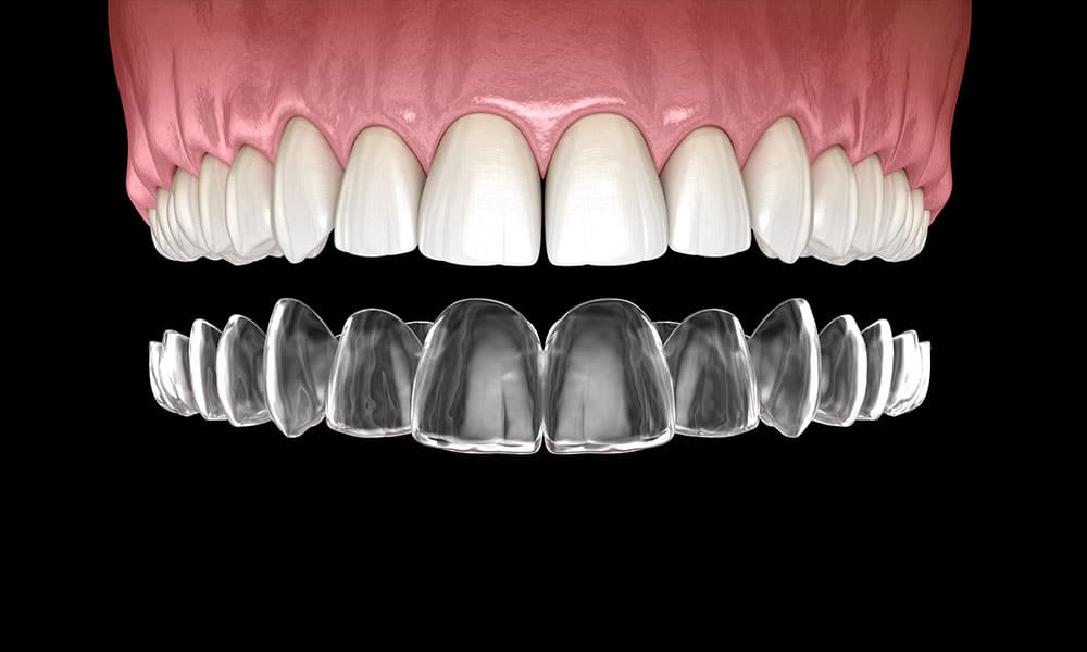 Everything You Need To Know About Invisalign