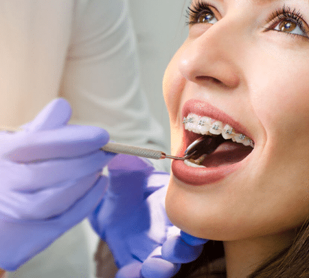 How Long Do I Have to Wear Braces?