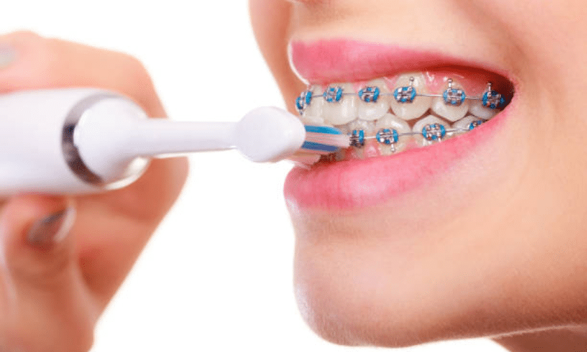 Tips for Brushing Your Teeth With Orthodontic Braces