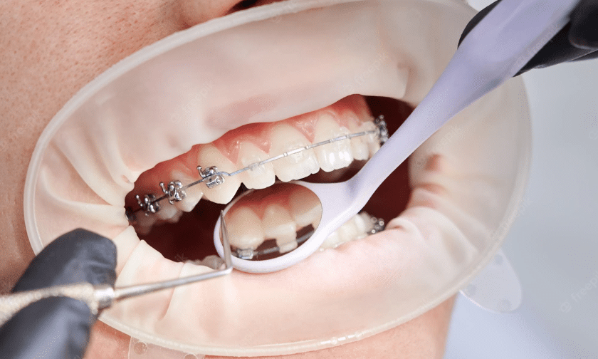 All You Need To Know About Early Orthodontic Treatment.