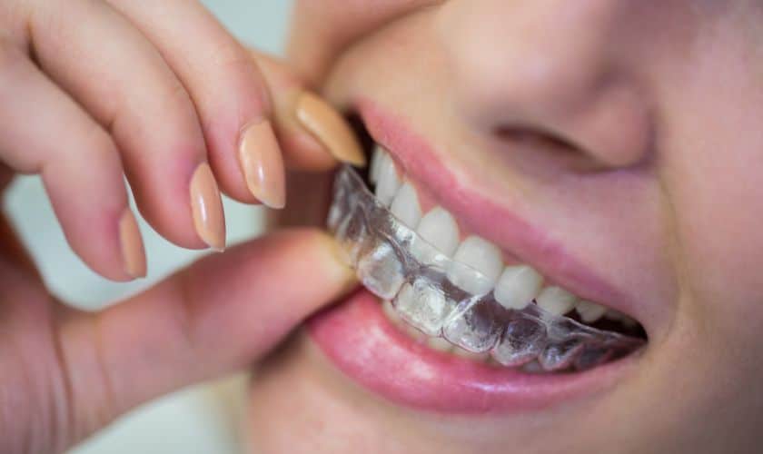 Invisalign in Woodbridge, VA