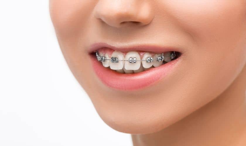 Braces vs invisalign in Woodbridge, VA
