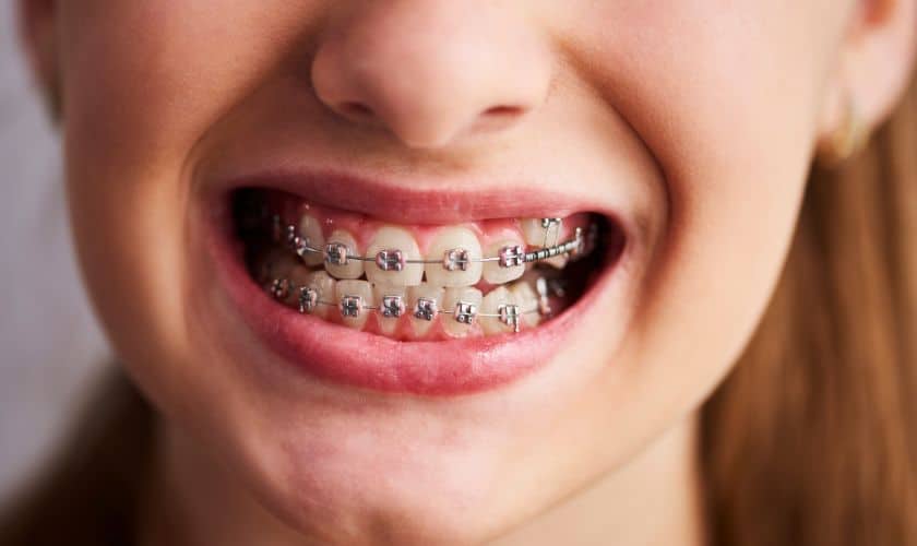 Braces in Woodbridge, VA