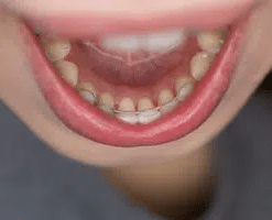 Close-up of smile showing teeth before orthodontic treatment with visible spacing and misalignment.