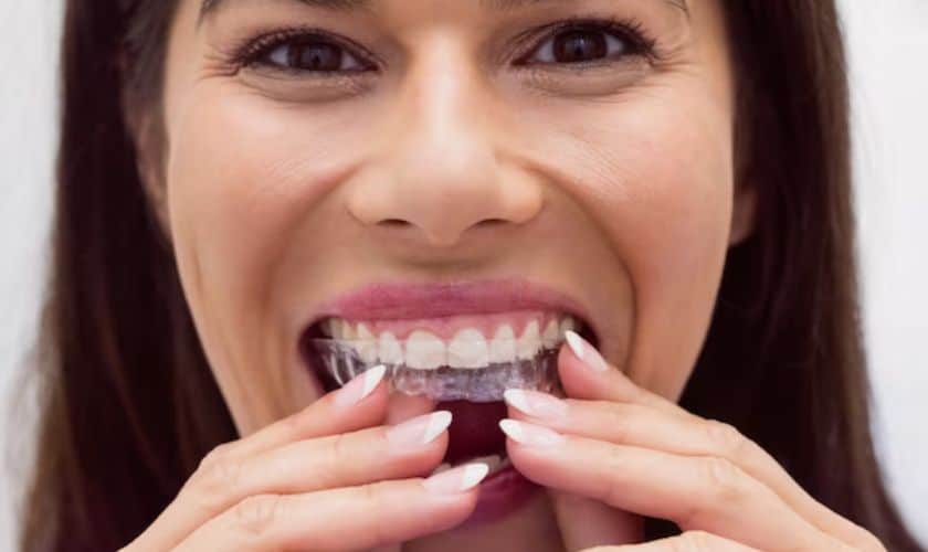 invisalign