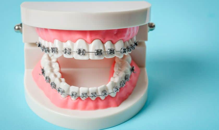 Clear Braces in Woodbridge