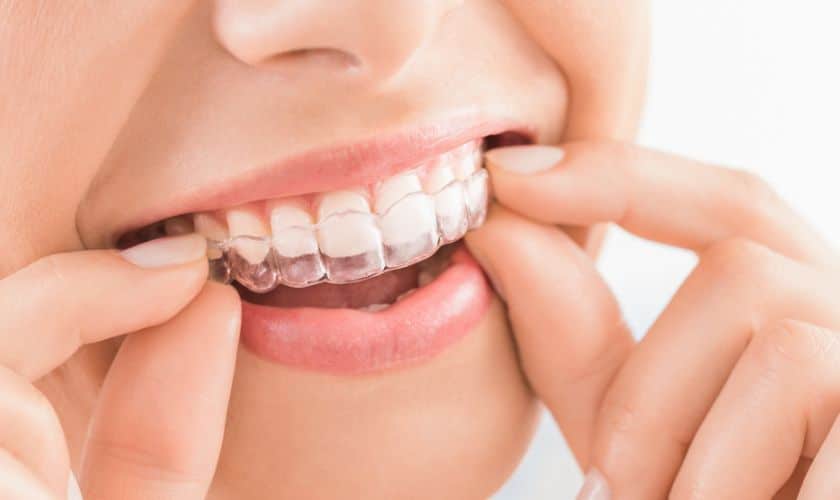 Seasonal Smiles: How To Maintain Your Invisalign Aligners During Christmas