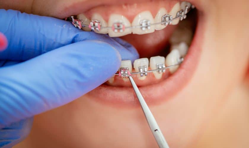 Fashionable And Festive: Styling Your Braces For New Year Celebrations
