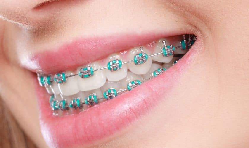 Smile Makeover: Enhancing Your Appearance With Clear Braces