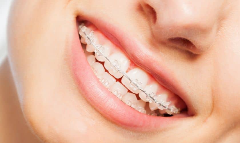 Clear braces Woodbridge