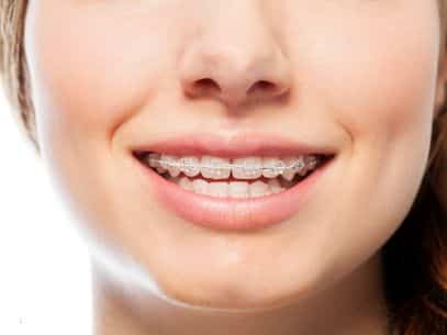 Clear braces in Woodbridge
