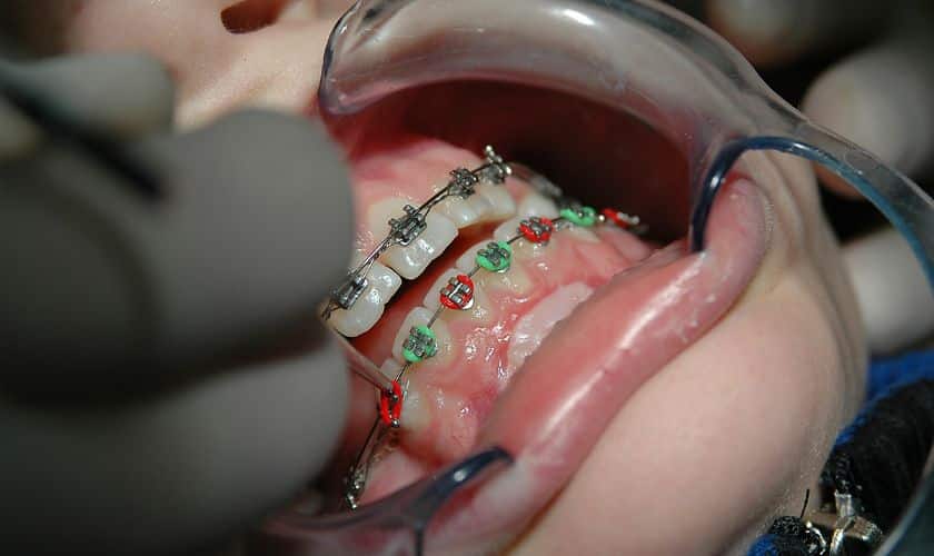 Braces in Woodbridge