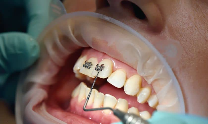 Braces in Woodbridge