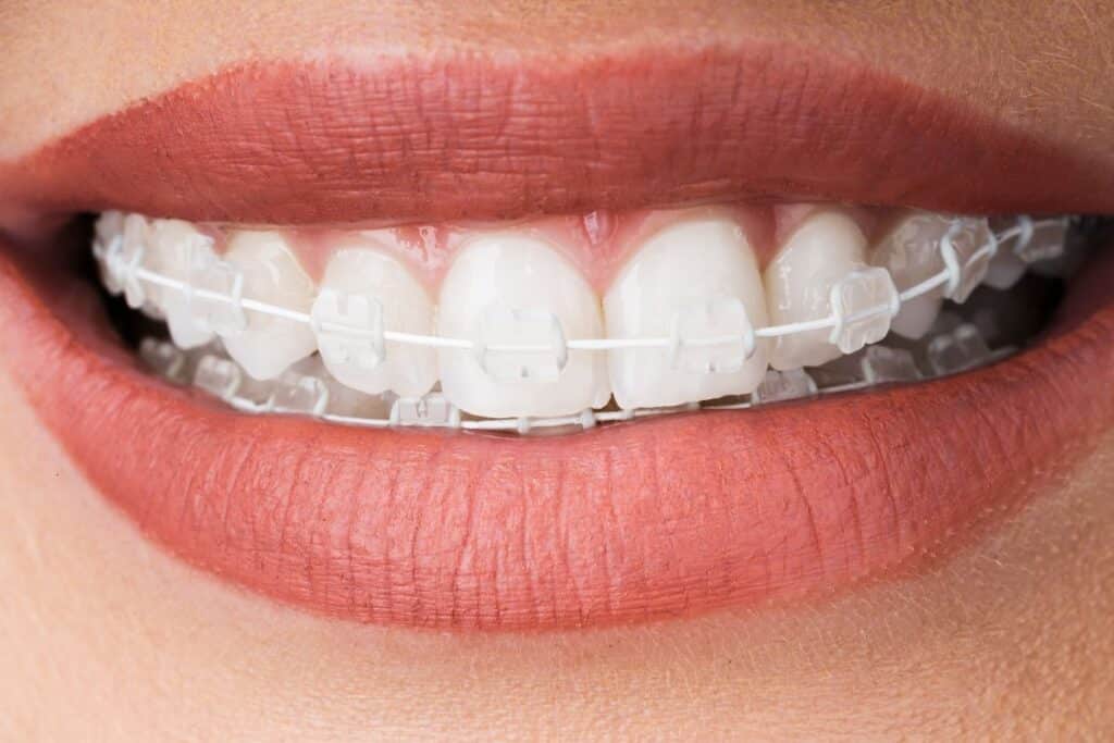 Braces in Woodbridge