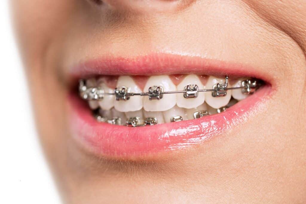 Braces in Woodbridge