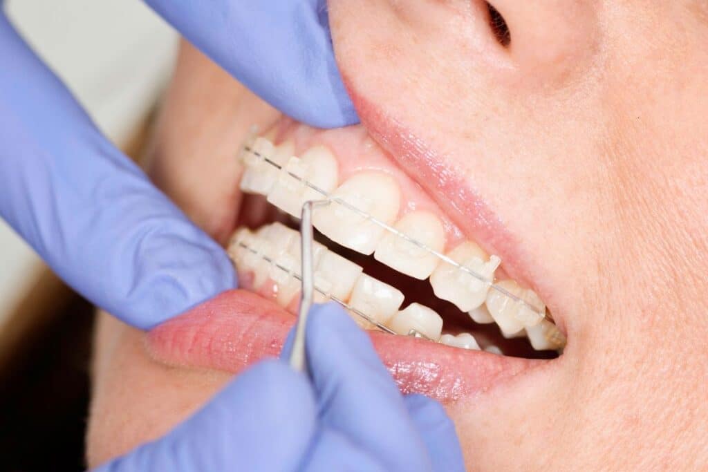 Orthodontist examining patient's teeth with dental tools during consultation appointment.
