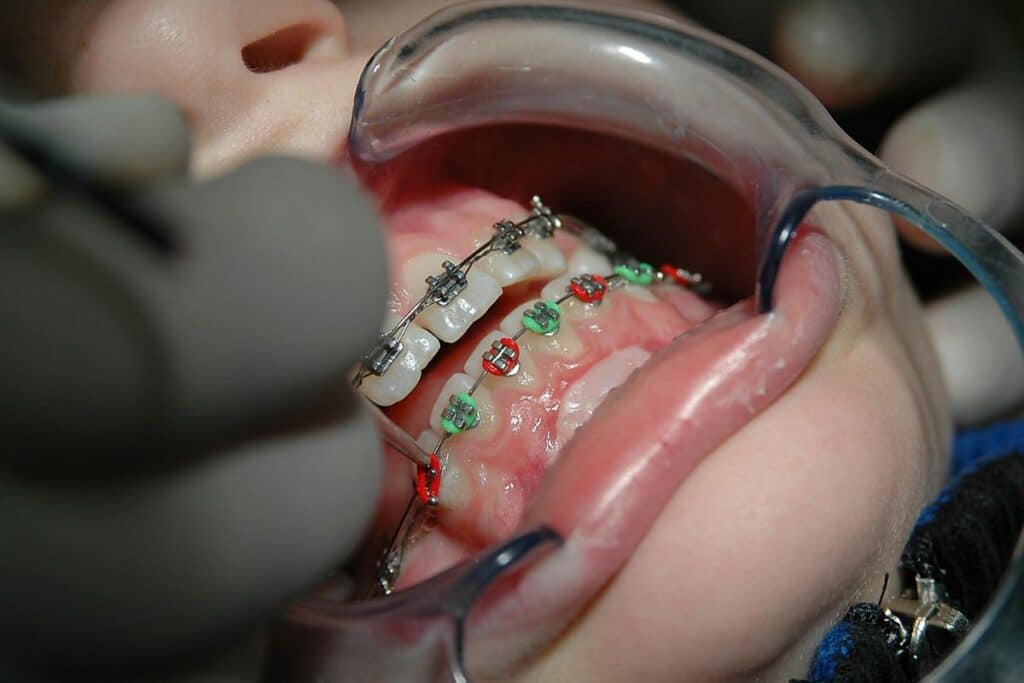 Braces in Woodbridge
