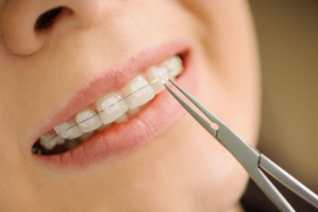clear braces in woodbridge