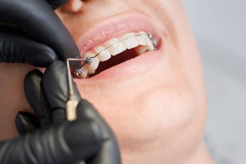clear braces in woodbridge