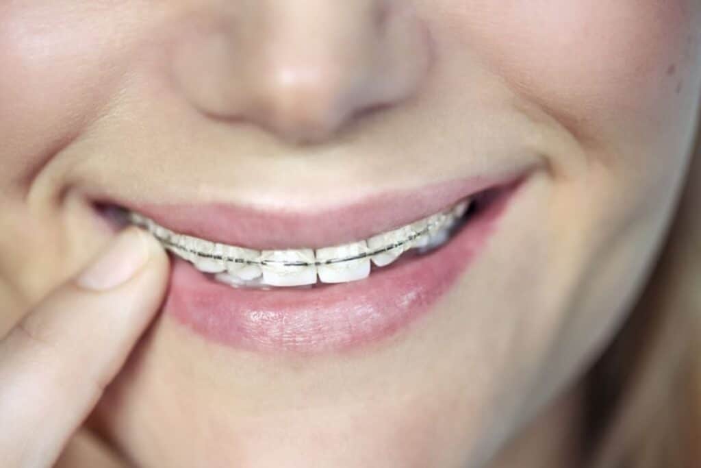 clear braces near me