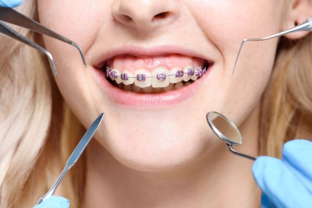 Clear braces in Woodbridge
