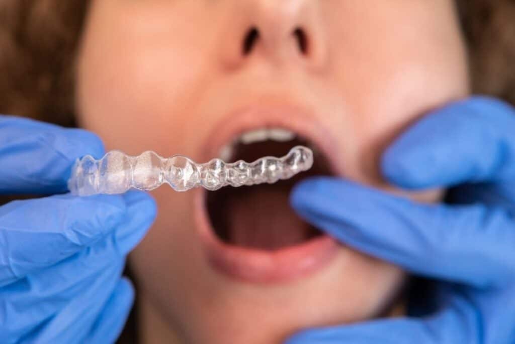 invisalign woodbridge