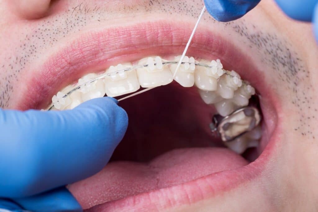 clear braces near me