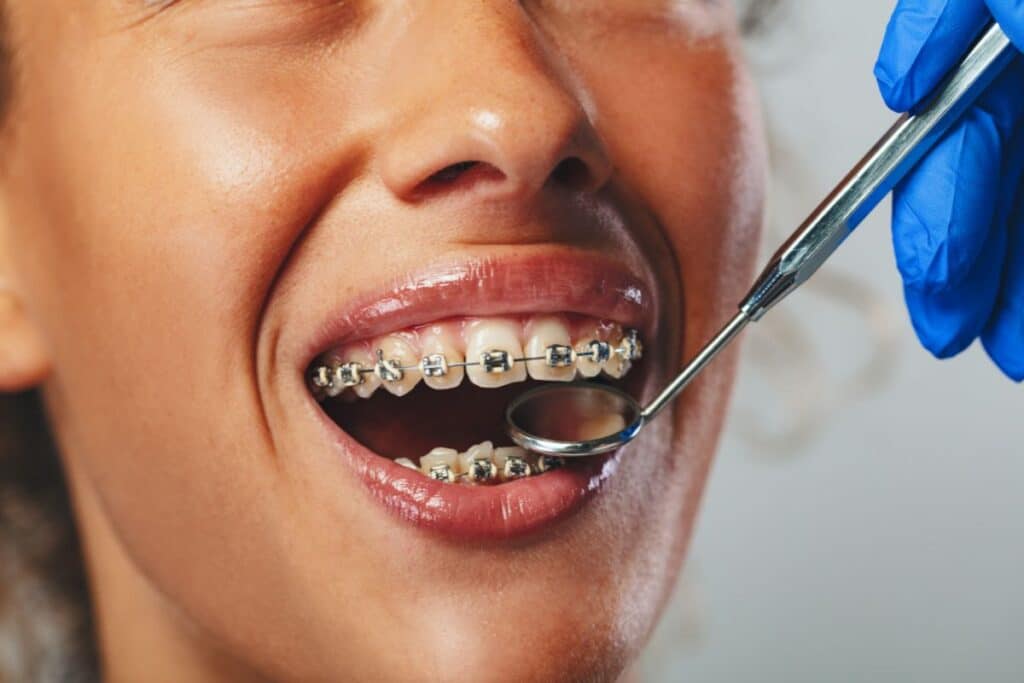 Patient displaying metal braces during orthodontic examination with dentist's tools and blue gloves visible.