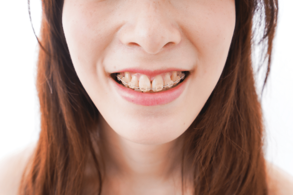 Clear Braces