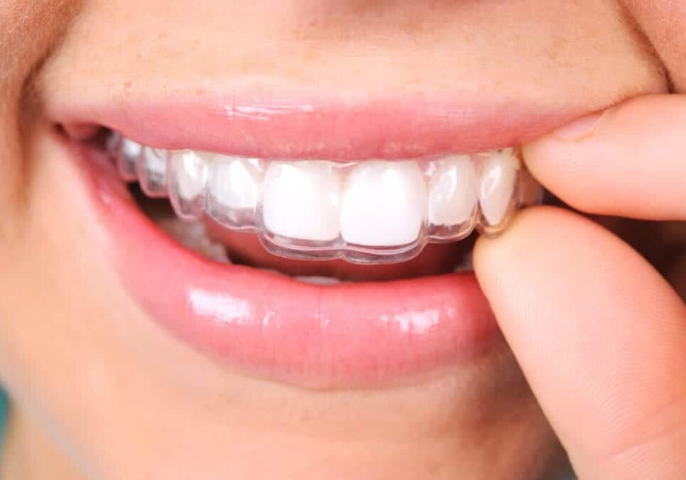 Close up of a person putting in a retainer.